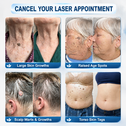 Upsell 𝐇𝐈𝐒𝐊𝐈𝐍®👩‍⚕️ 𝟕-𝐃𝒂𝘆 𝐒𝗸𝐢𝐧 𝐓𝒂𝗴 & 𝐒𝐩𝙤𝐭 𝐄𝐫𝒂𝐬𝙚𝐫 Painless & Scar-Free Advanced Imperfection Removal Rollerball Pen (Copy)