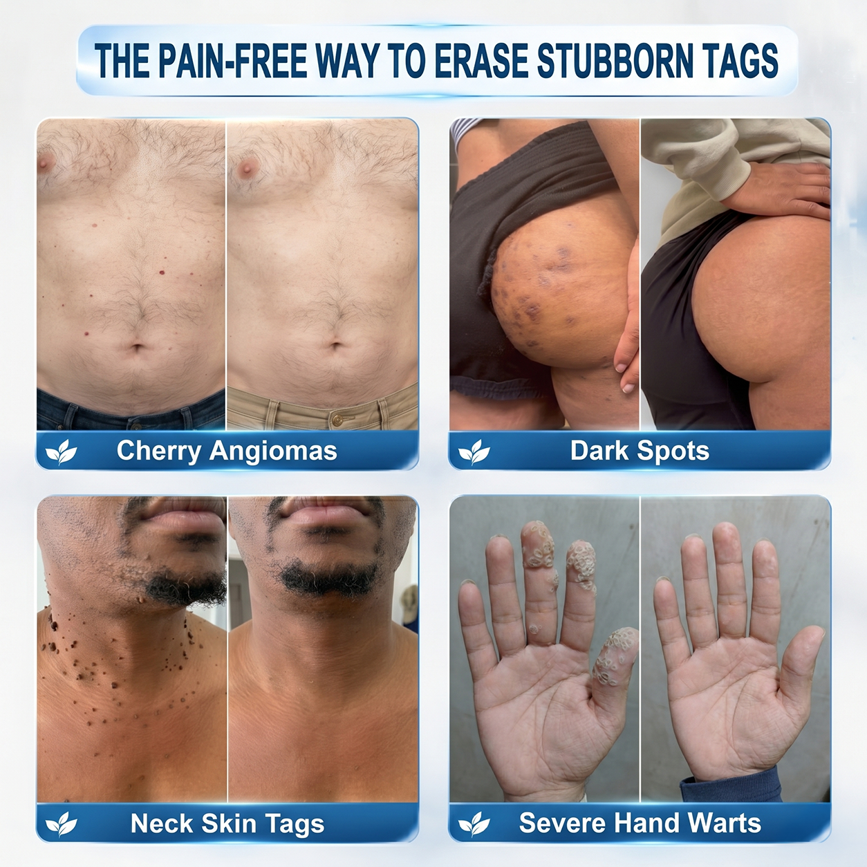 Upsell 𝐇𝐈𝐒𝐊𝐈𝐍®👩‍⚕️ 𝟕-𝐃𝒂𝘆 𝐒𝗸𝐢𝐧 𝐓𝒂𝗴 & 𝐒𝐩𝙤𝐭 𝐄𝐫𝒂𝐬𝙚𝐫 Painless & Scar-Free Advanced Imperfection Removal Rollerball Pen (Copy)