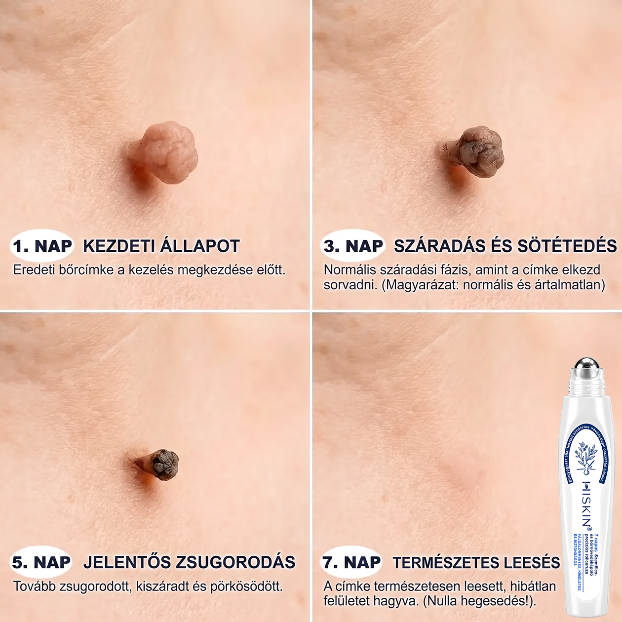 🌿 HiSkin® 🎁 Egy utolsó, még jobb ajánlat! Szerezz be most egy extra HiSkin®-t 50% kedvezménnyel, hogy megszakítás nélkül folytathasd a kezelést.