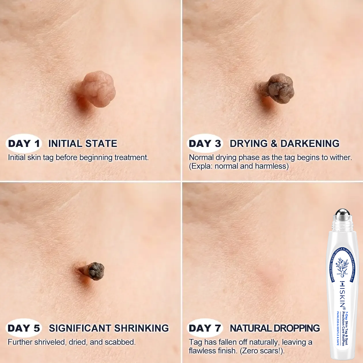 Upsell 𝐇𝐈𝐒𝐊𝐈𝐍®👩‍⚕️ 𝟕-𝐃𝒂𝘆 𝐒𝗸𝐢𝐧 𝐓𝒂𝗴 & 𝐒𝐩𝙤𝐭 𝐄𝐫𝒂𝐬𝙚𝐫 Painless & Scar-Free Advanced Imperfection Removal Rollerball Pen (Copy)
